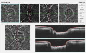 Angiografia oct della testa del nervo-ottico