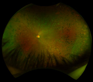 panretinografia-in-retinopatia-diabetica-esiti-panfotocoagulazione